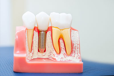 Granger Dentistry | LANAP reg , Dental Lab and Oral Exams