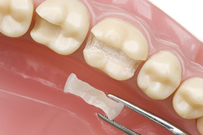 Granger Dentistry | ClearCorrect reg , Preventative Program and Implant Restorations
