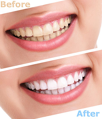 Granger Dentistry | Air Abrasion, Preventative Program and Botox reg 