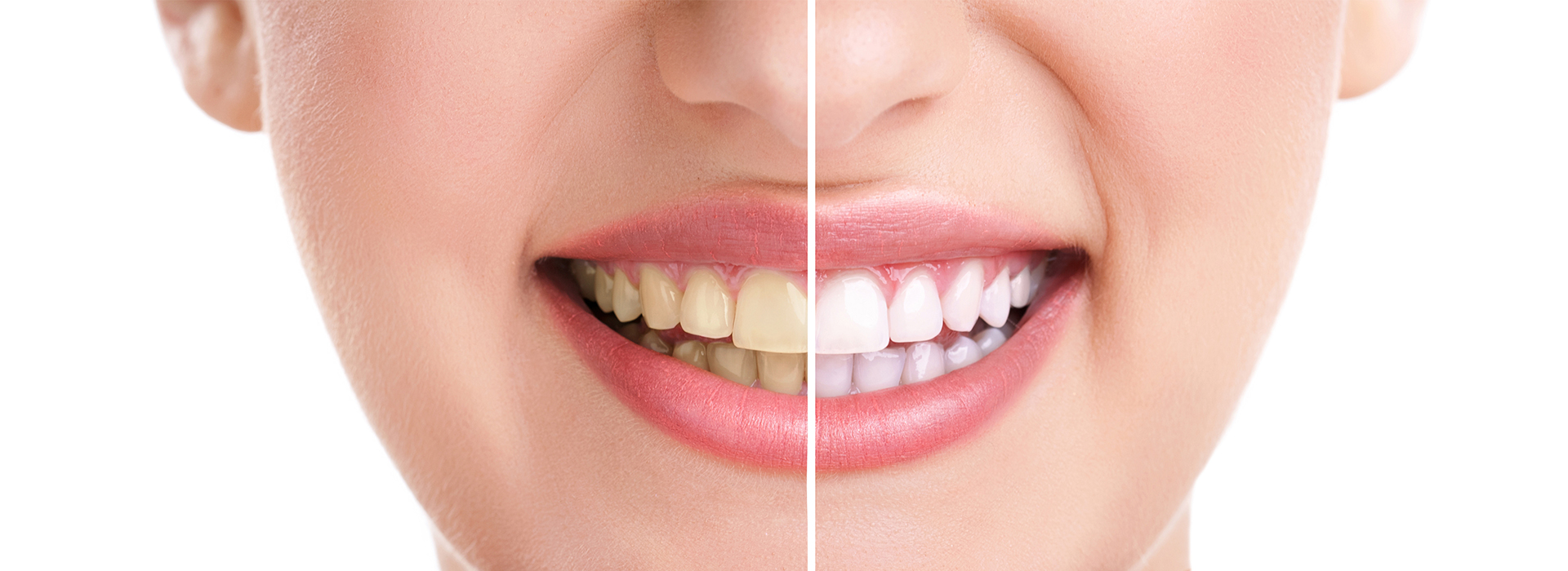 Granger Dentistry | E4D, Oral Cancer Screening and Veneers