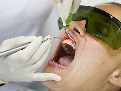 Granger Dentistry | Air Abrasion, Crowns  amp  Caps and LANAP reg 