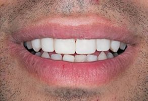 Granger Dentistry | Ceramic Crowns, Air Abrasion and ZOOM  Whitening
